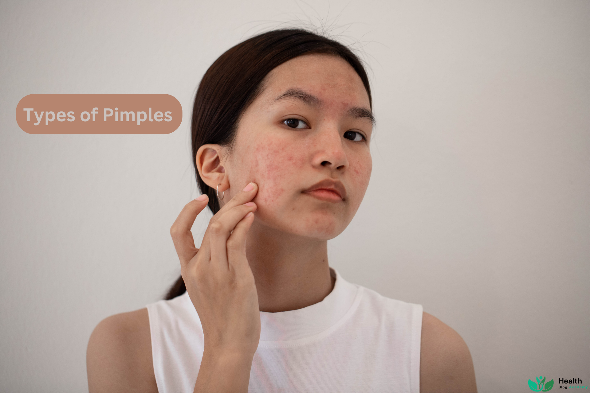 Types of Pimples